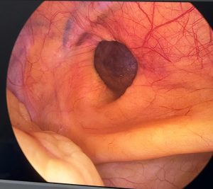 A closeup diagram, representing a surgical case by Dr. Rakesh Dhupia best surgeon in Indore.