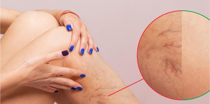 Varicose Vein Treatment at Care & Cure by Dr. Rakesh Dhupia Indore