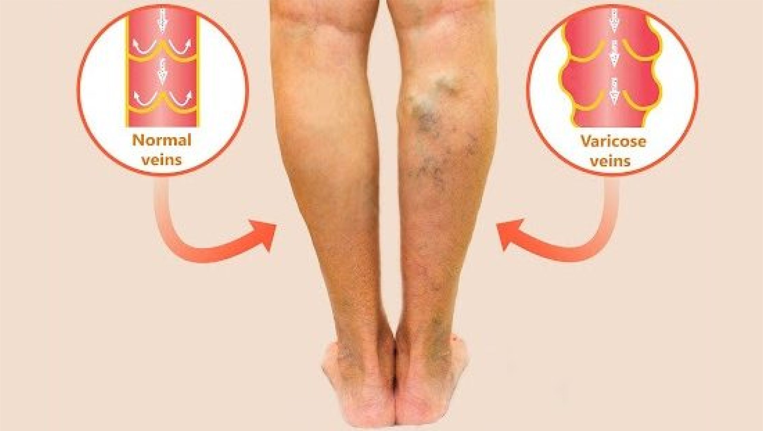 6 Signs You Might Need Varicose Veins Surgery