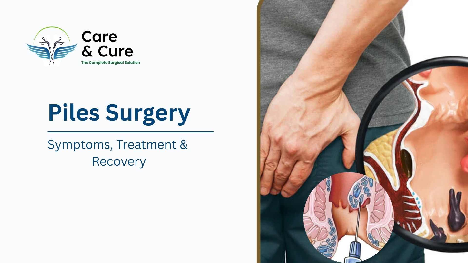 Piles Surgery: Guide to Causes, Symptoms, Treatment & Recovery