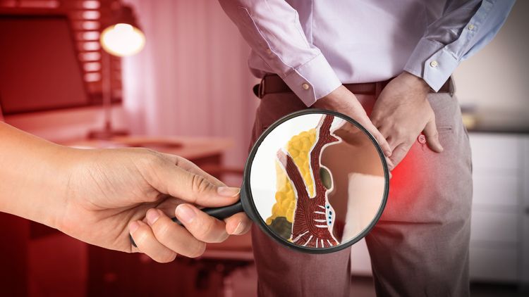 When Do Piles Need Surgery? Guide to All 4 Stages of Hemorrhoids
