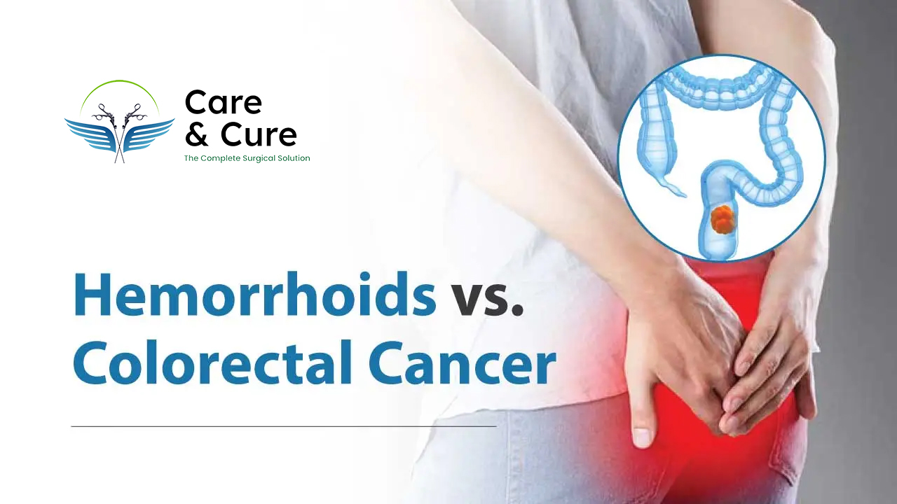 Can Piles Cause Cancer? Understanding the Link Between Hemorrhoids and Colorectal Cancer
