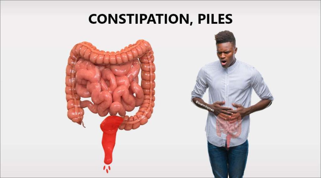 Constipation and Piles