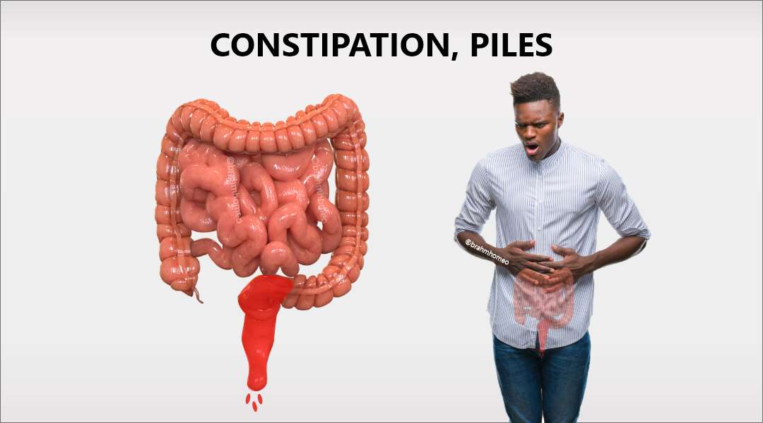 How Constipation Can Lead to Piles? The Link Between Constipation and Piles: Breaking the Cycle