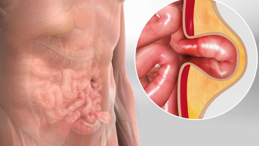 When Does a Hernia Become a Surgical Emergency?