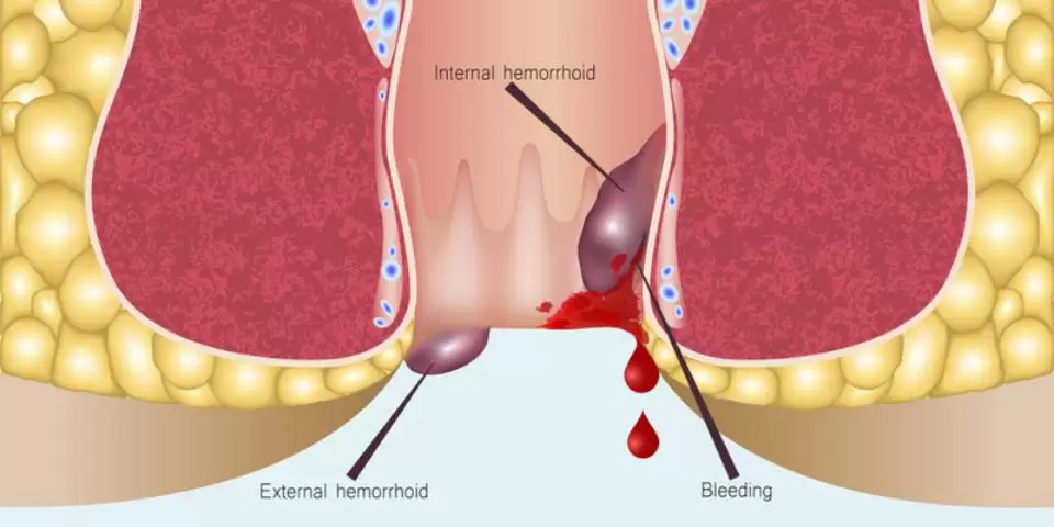 Rectal Bleeding: 6 Warning Signs You Must Not Ignore