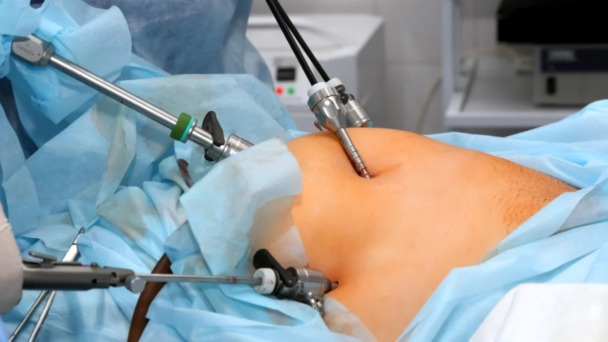 What Is Laparoscopic Surgery and Why It’s Preferred Today