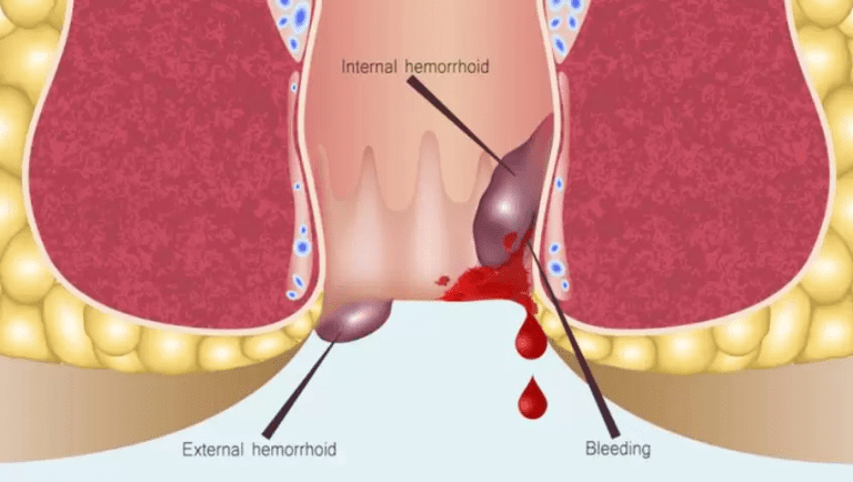 Rectal Bleeding: 6 Warning Signs You Must Not Ignore - Dr. Rakesh Dhupia