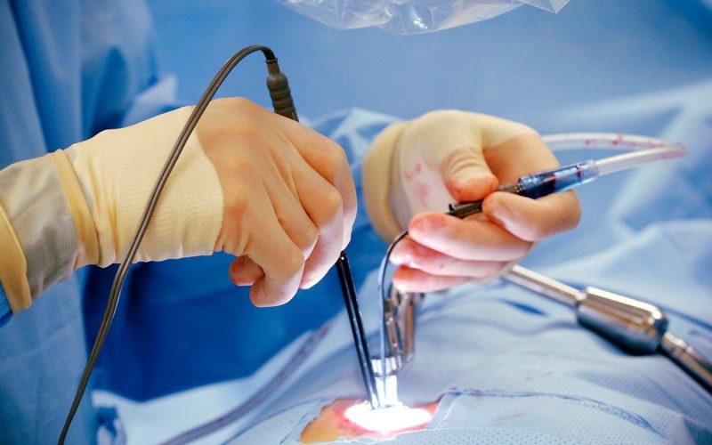 Laser Hemorrhoidectomy