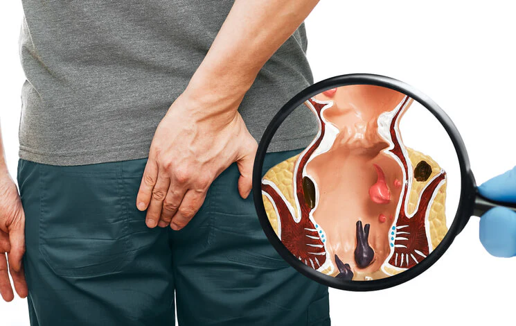 Piles Causes And Symptoms