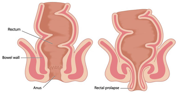 Rectal prolapse