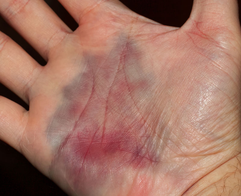 hematoma