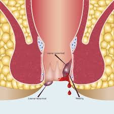 hemorrhoids