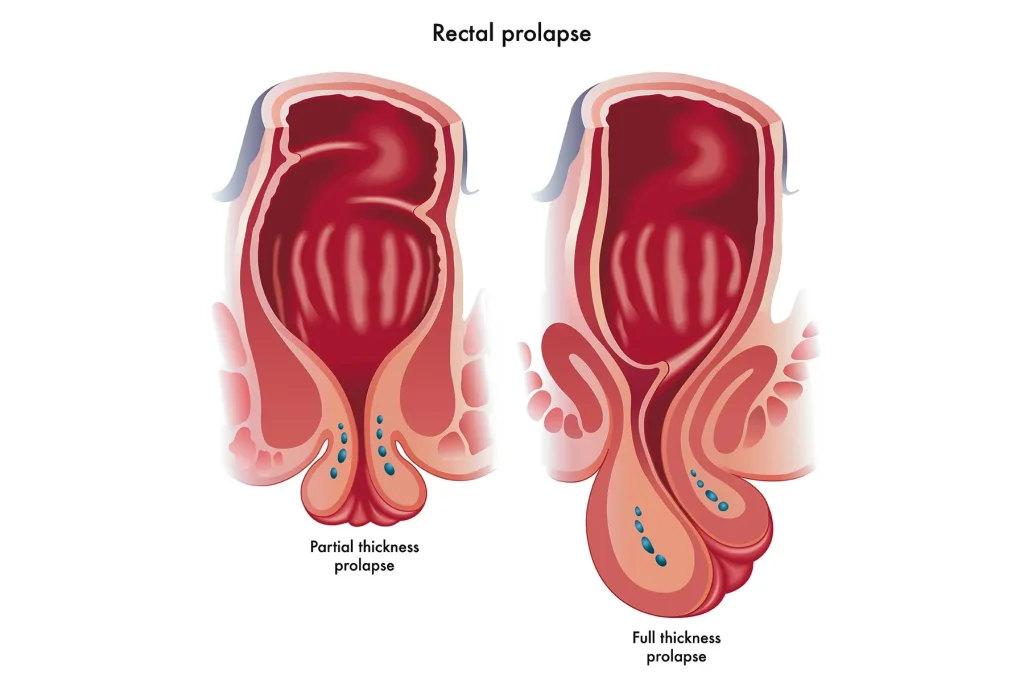 rectum is lifted