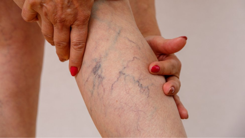 Laser Treatment for Varicose Veins: Is It Worth It?