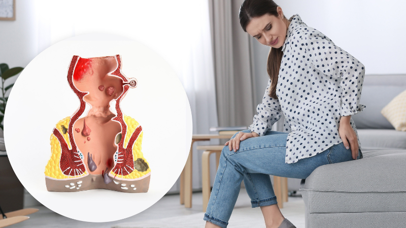 Why Laser Treatment Is the Future of Anal Fissure Care