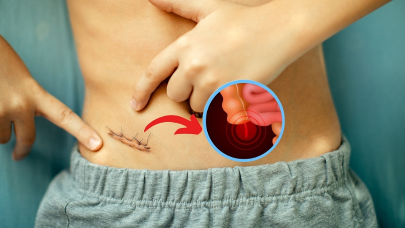 Appendix Pain: How to Know If You Need Surgery