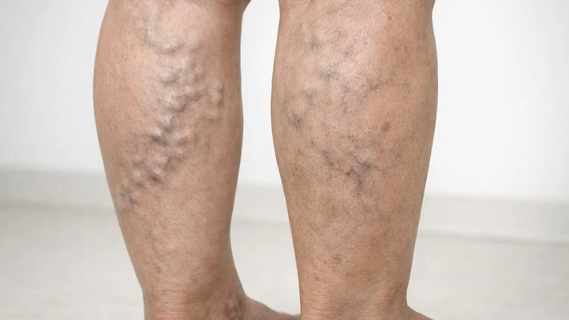 Are Varicose Veins Dangerous? When to Get Medical Help