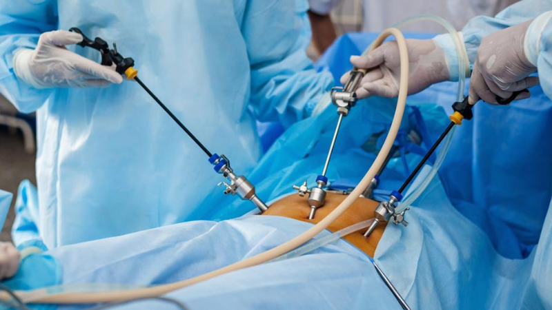 Recovery Tips After Laparoscopic Surgery: A Quick Healing Guide