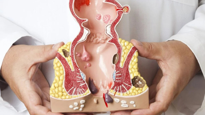 Is That Anal Pain a Fissure, Fistula, or Hemorrhoid? Here’s How to Tell