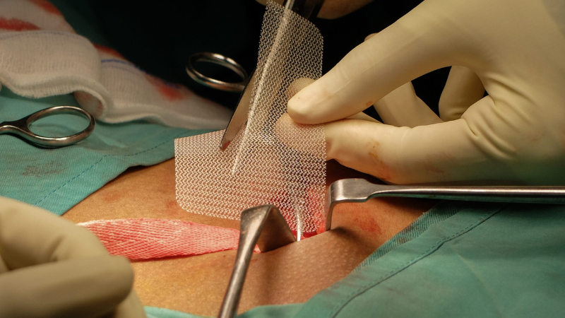 Mesh Repair for Hernia: Benefits, Risks & Long-Term Success